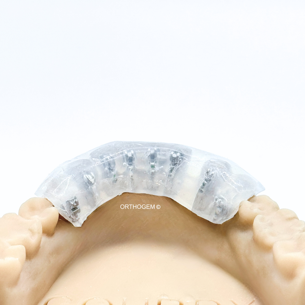 Brackets en collage indirect