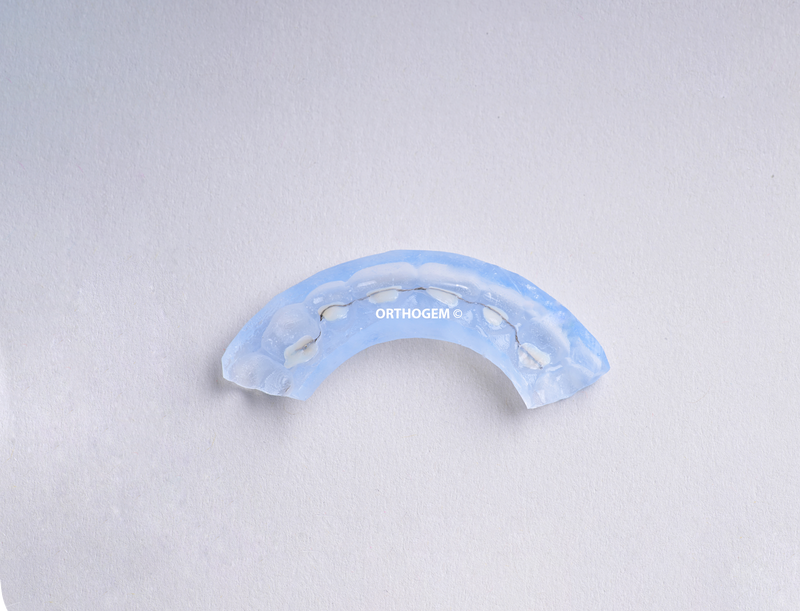 fil de contention 3 3 indirect par Orthogem laboratoire spécialisé en prothèse ODF et orthodontie en France qualité réglage rapidité
