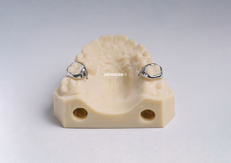Bagues anatomiques fourreaux palatin vestibulaire par Orthogem laboratoire spécialisé en prothèse ODF et orthodontie en France qualité réglage rapidité