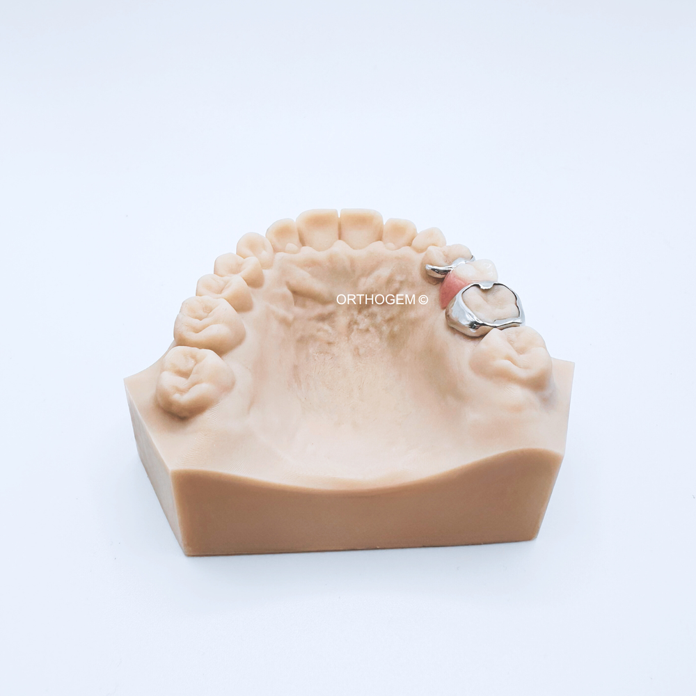 Mainteneur d'espace avec bague anatomique et dent prothétique