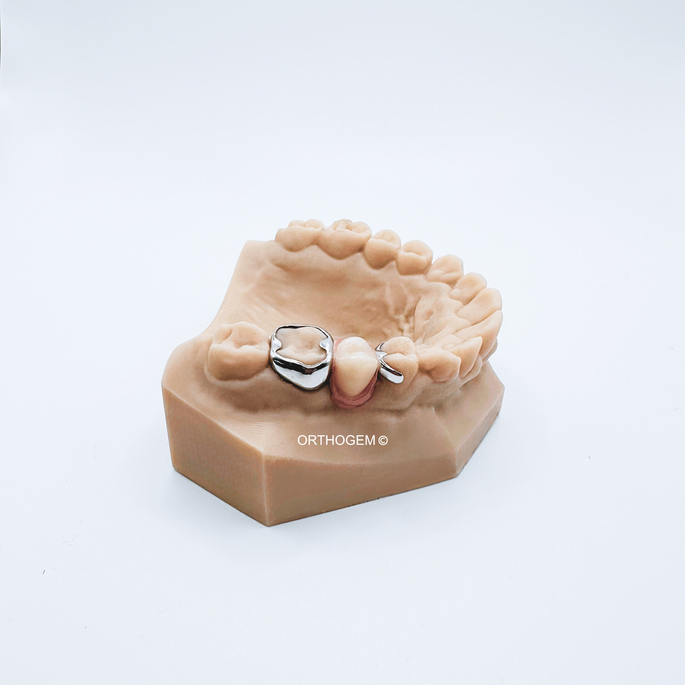 Mainteneur d'espace avec bague anatomique et dent prothétique