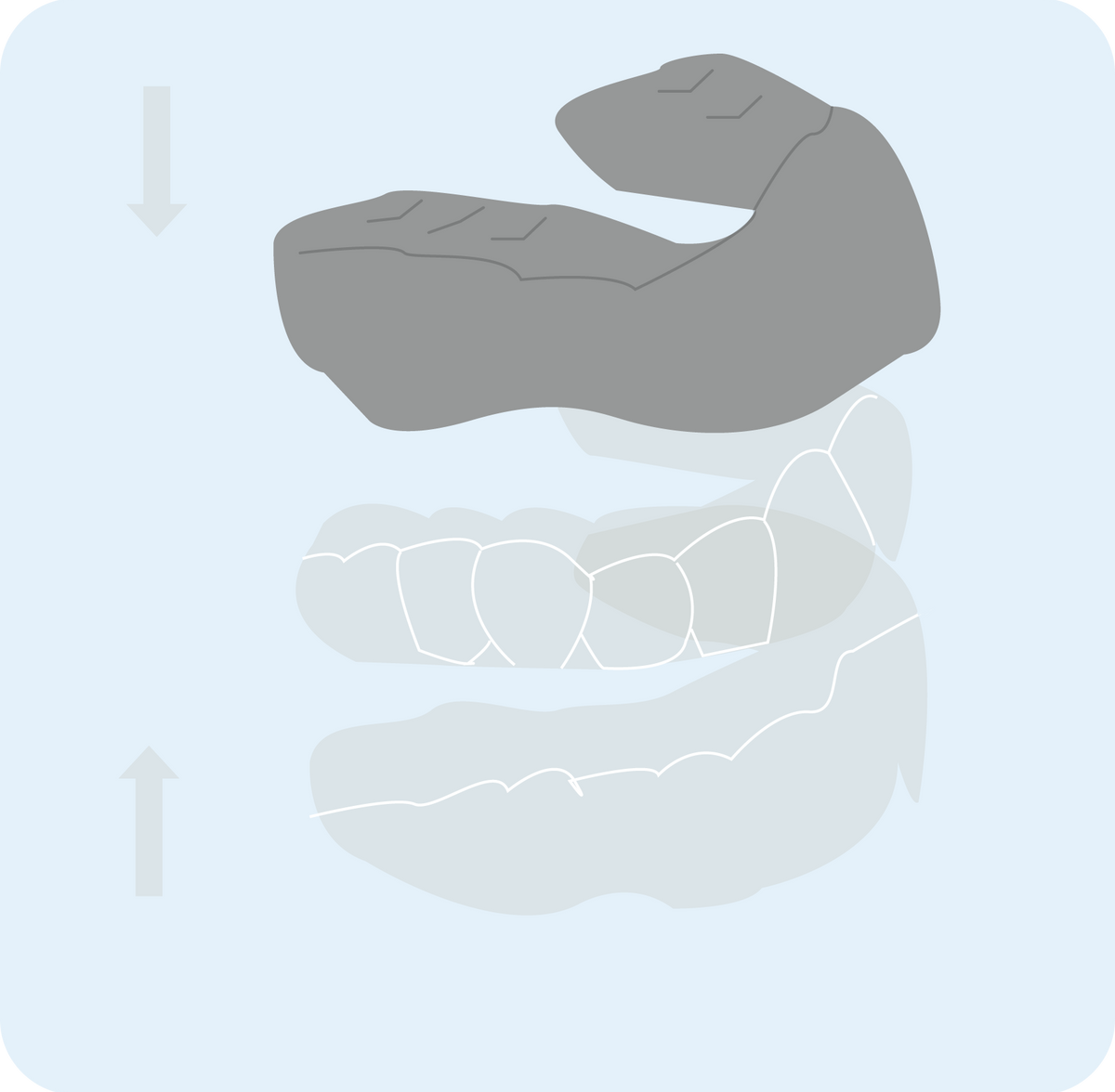 Protège-dents sur mesure 3 couches protection souple mou dur professionnel laboratoire Orthogem ODF orthodontie